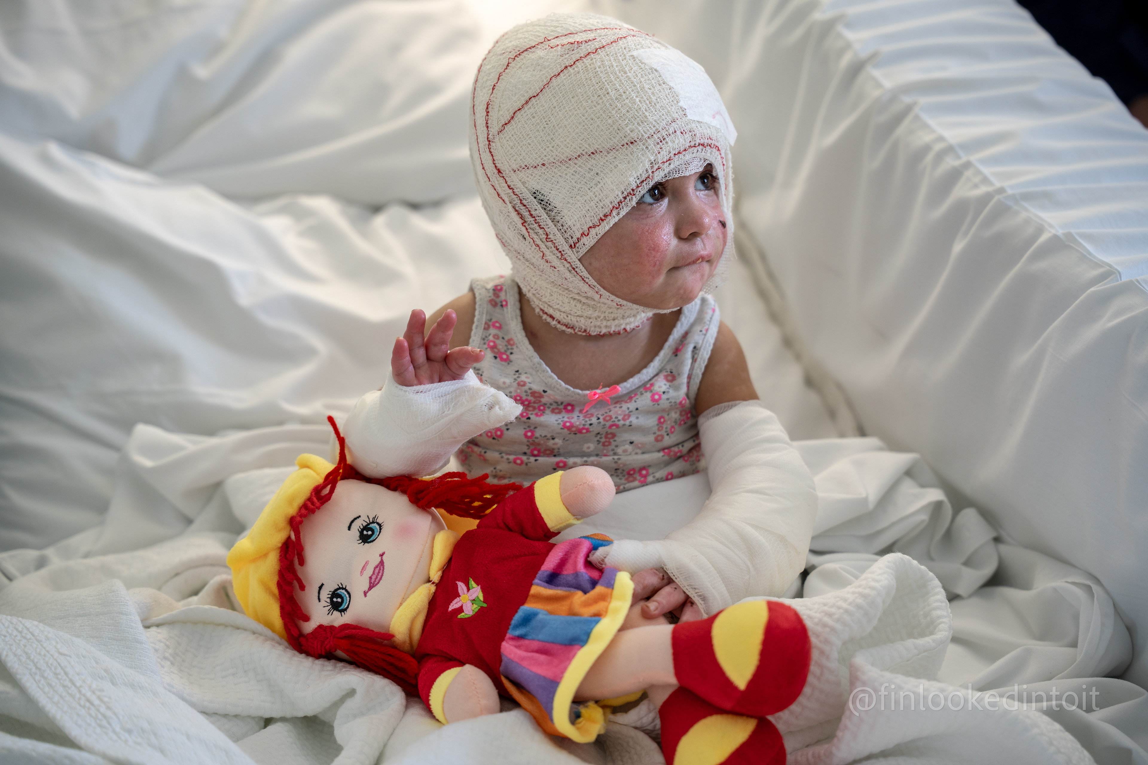 Two-year-old Ivana Zeyhoun being treated for third degree burns from an Israeli airstrike in Beirut's Geitoui hospital, 11/1/2024